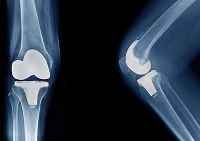 Knee Replacement